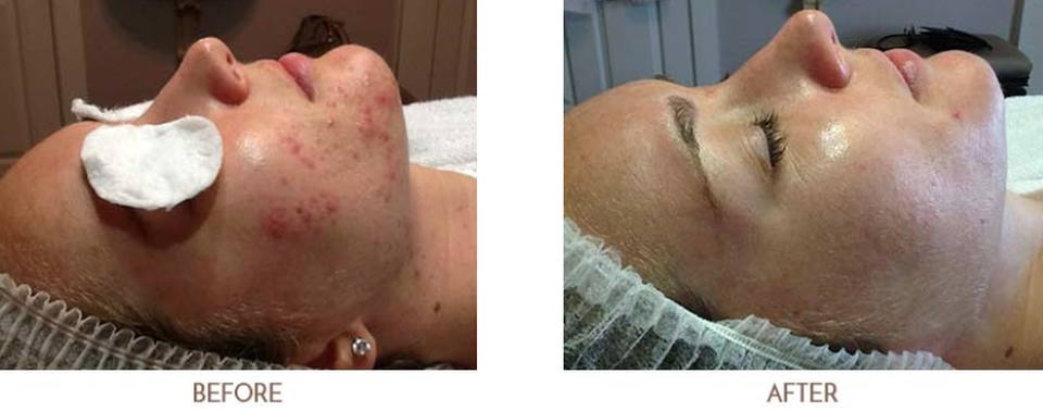 Acne Before Case 1